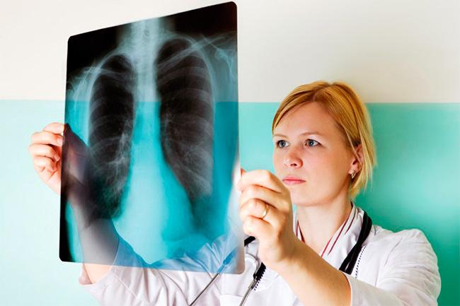 В Удмуртии смертность от туберкулеза снизилась на 16%