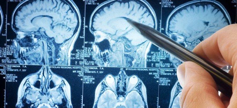 Российские ученые доказали влияние стресса на развитие деменции