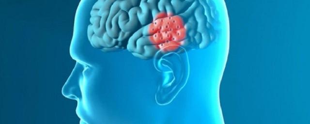 Ученые: Удаление «клеток-зомби» из мозга защитит от болезни Паркинсона