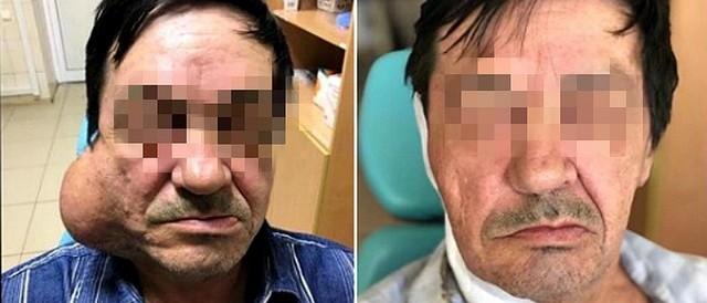 Краснодарские врачи удалили крупную опухоль с лица мужчины