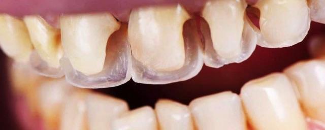 Восстановление зубов при помощи композитных материалов
