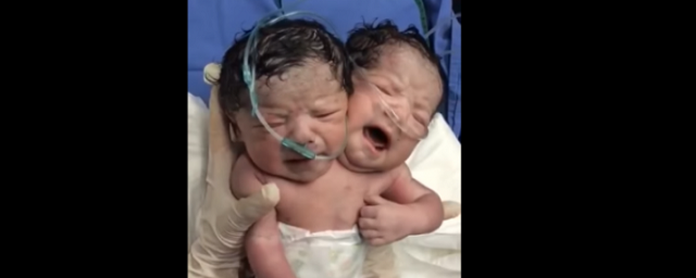 В Мексике родился ребенок с двумя головами