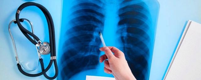 В Вологодской области снизилась смертность от туберкулеза