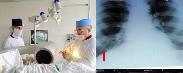 В КБР врачи извлекли пулю из груди пациента, спустя 30 лет после ранения