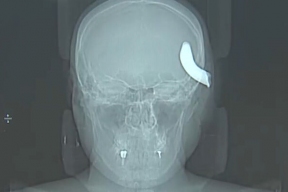 В Петербурге нейрохирурги извлекли из черепа молодого мужчины металлический крюк от буксировочного троса