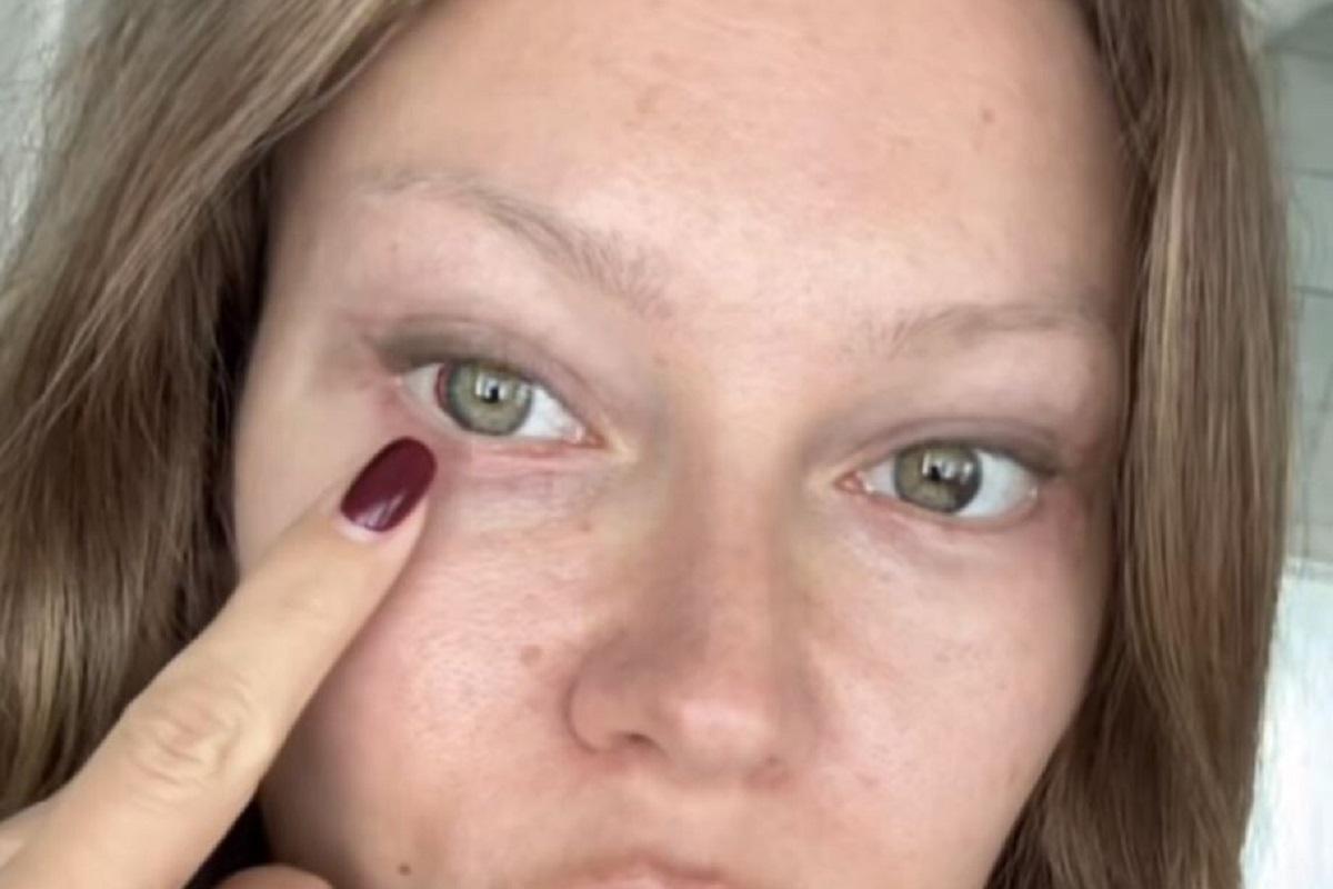 Рита Дакота показала результат повторной блефаропластики