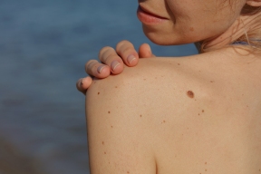 Стало известно, кто больше всего подвержен раку кожи