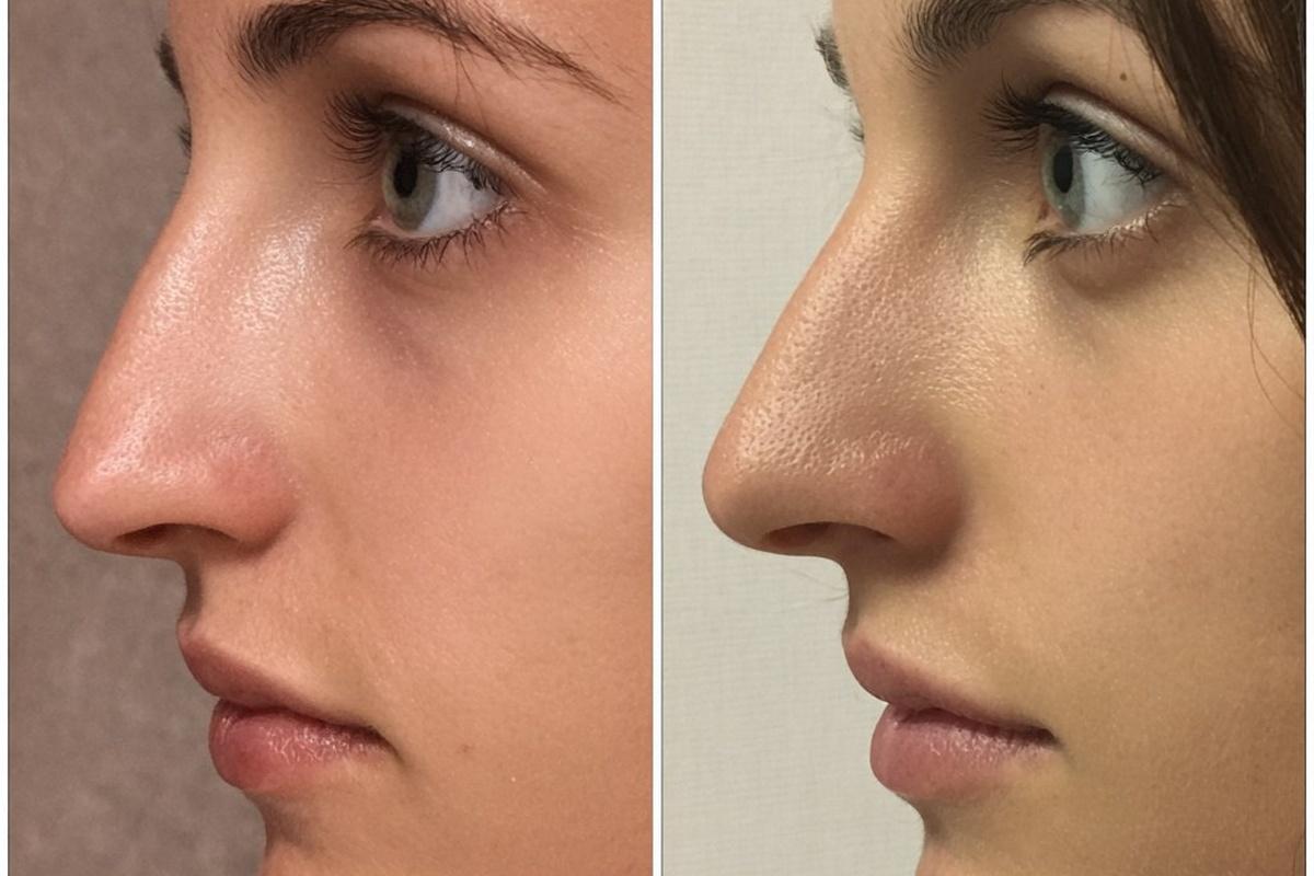 Непростые симптомы: пластический хирург назвал пять сигналов, которые указывают на необходимость ринопластики