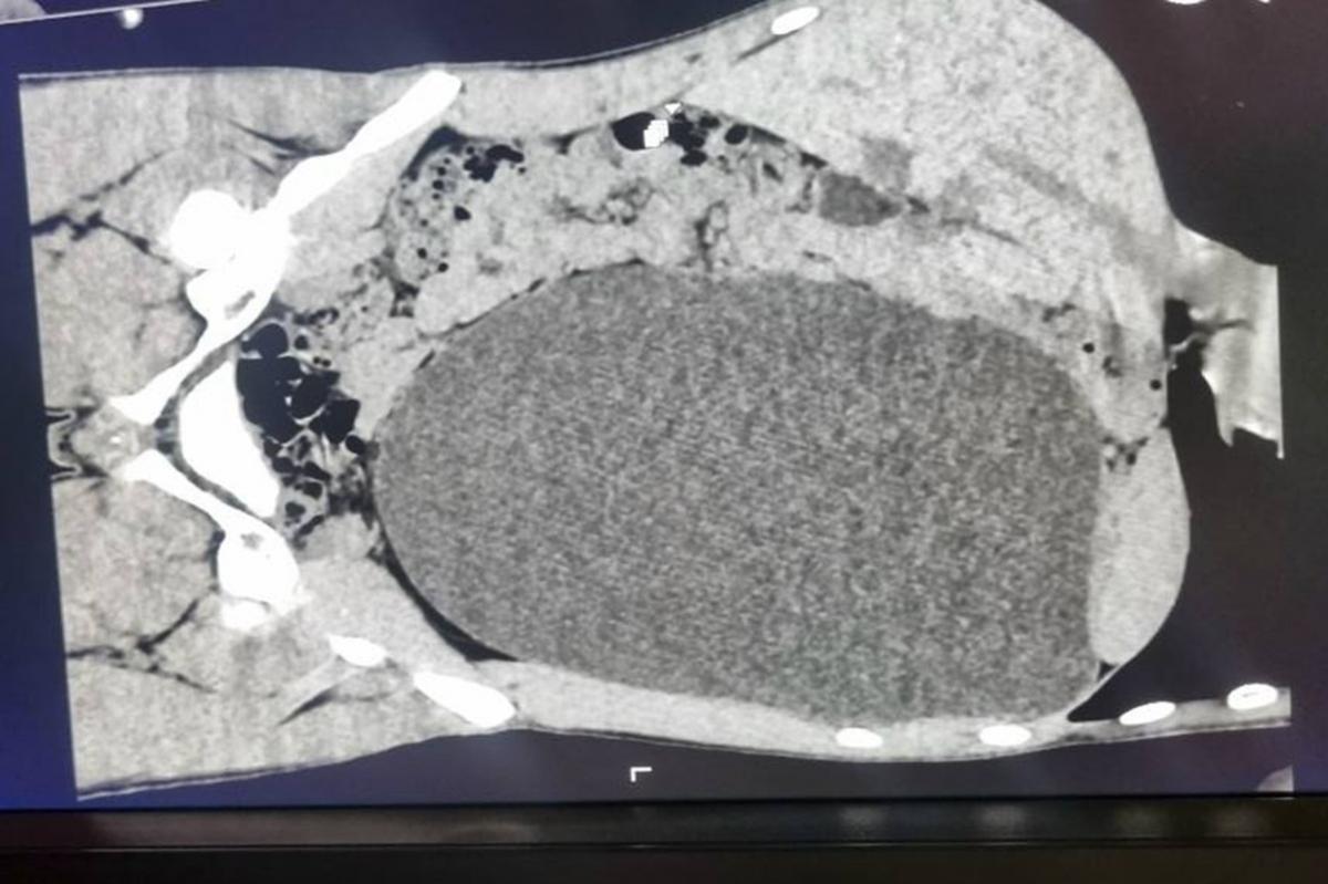 В Новосибирске у подростка при устройстве на работу нашли почку размером с пятилитровую бутыль