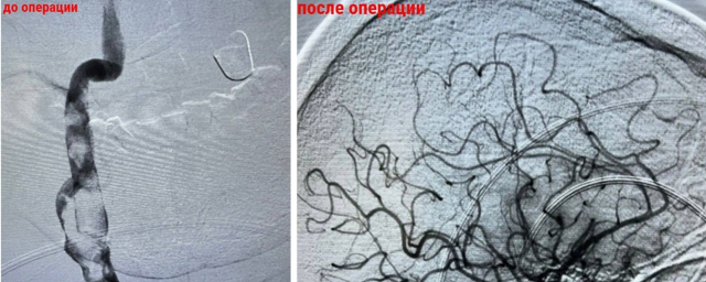Врачи Красногорской ГБ удалили из артерии головного мозга пациента трехсантиметровый тромб
