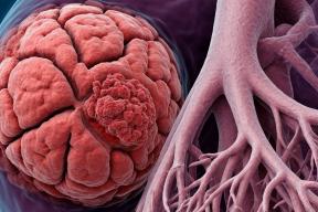 Минздрав России просят ввести КТ для ранней диагностики рака легких