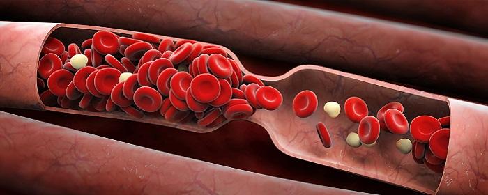 Кардиолог Кореневич рассказала об опасности густой крови
