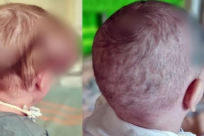 Московские врачи выкачали больше литра жидкости из головы 2-летней забайкальской девочки