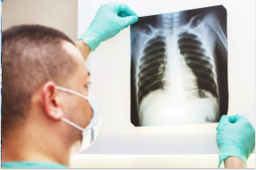 В России 70% случаев рака легких выявляют слишком поздно