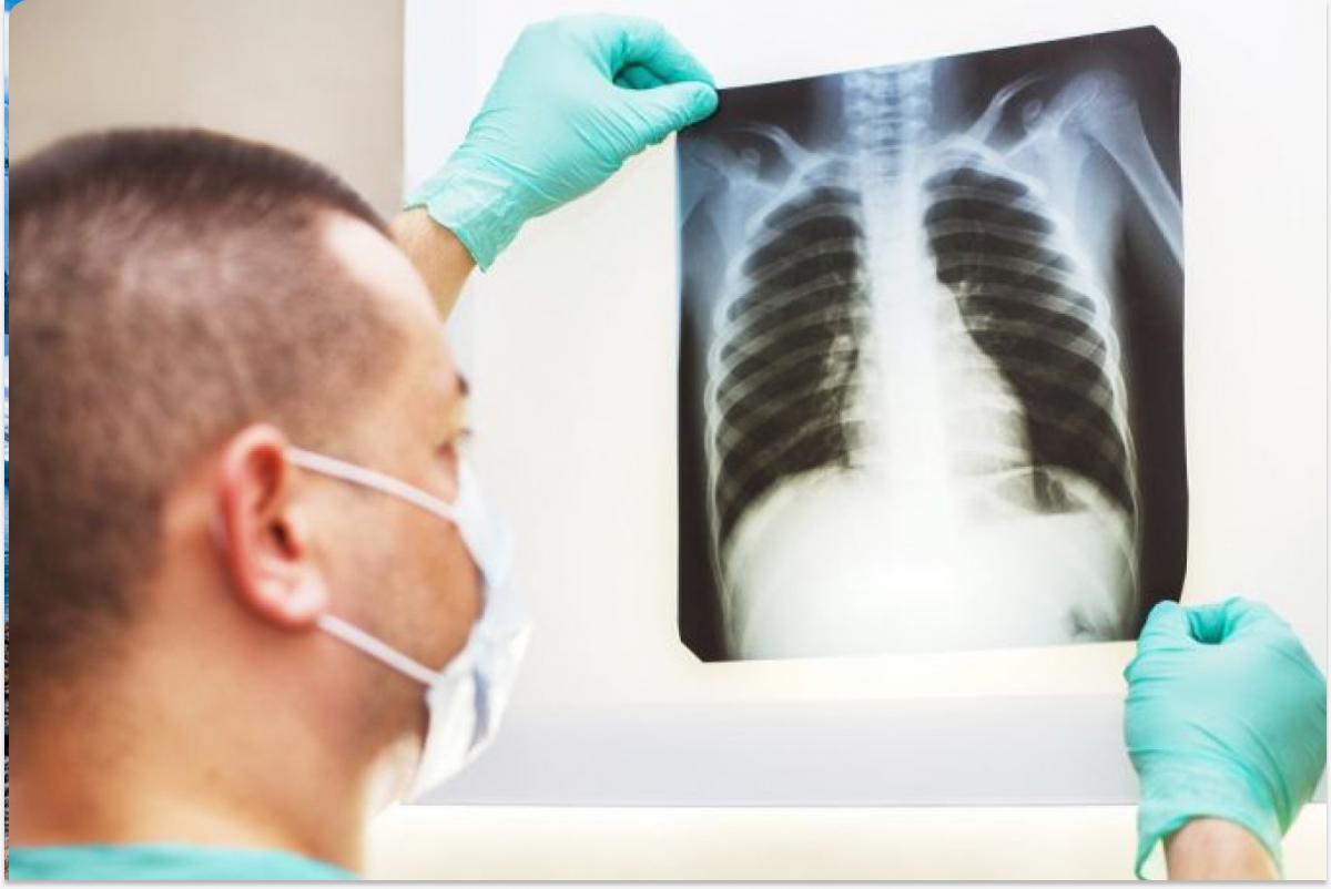 В России 70% случаев рака легких выявляют слишком поздно