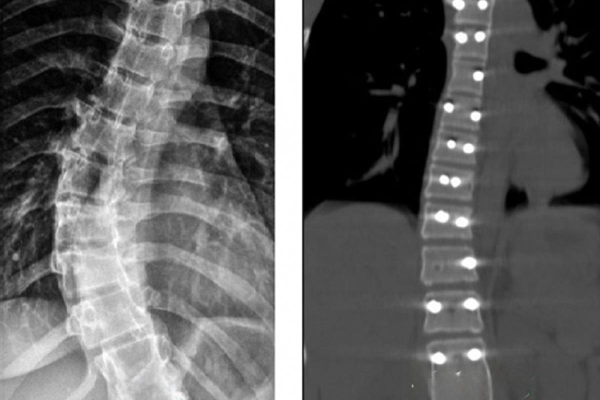 Нейрохирурги Ставрополя провели уникальную операцию пациентке с изгибом позвоночника в 40 градусов