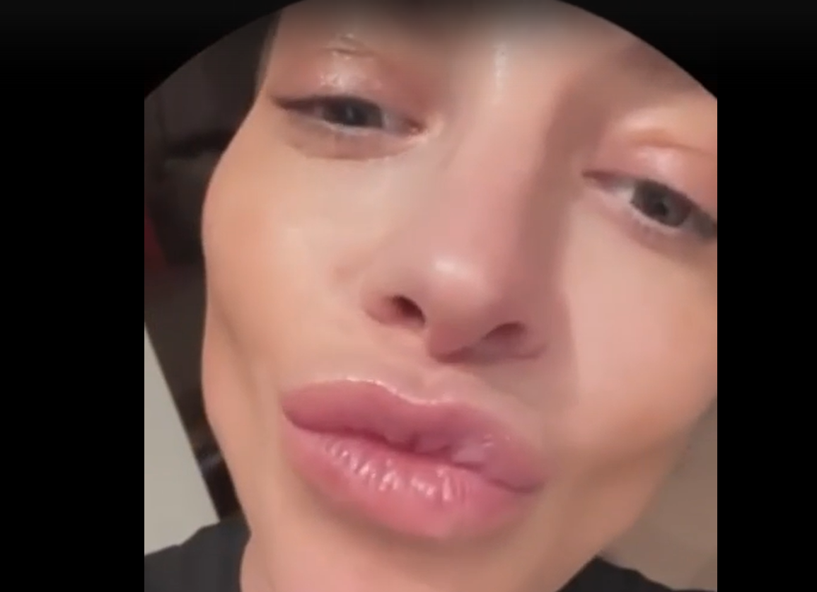 Экс-участница Comedy Woman удалила филлеры из губ