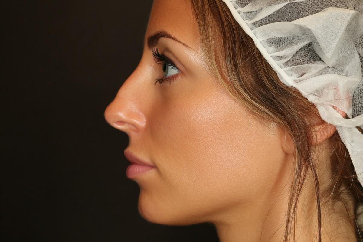 Как ринопластика преображает не только нос, но и жизнь