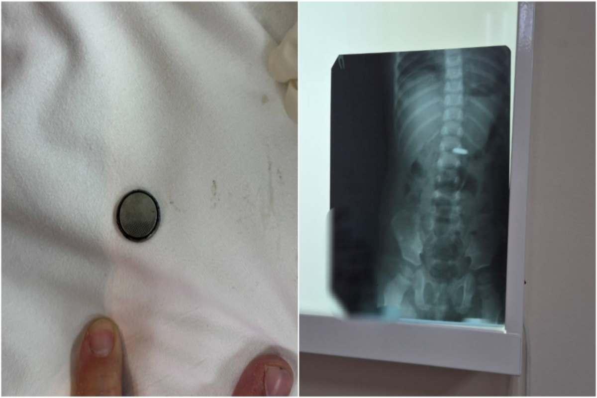 В Саратовской области врач предупредила об опасности, которую несет батарейка, попав ЖКТ ребенка