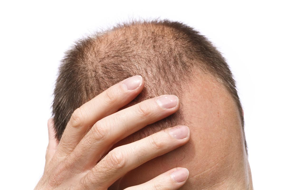 Ученые рассказали, чем можно заменить популярные препараты для роста волос