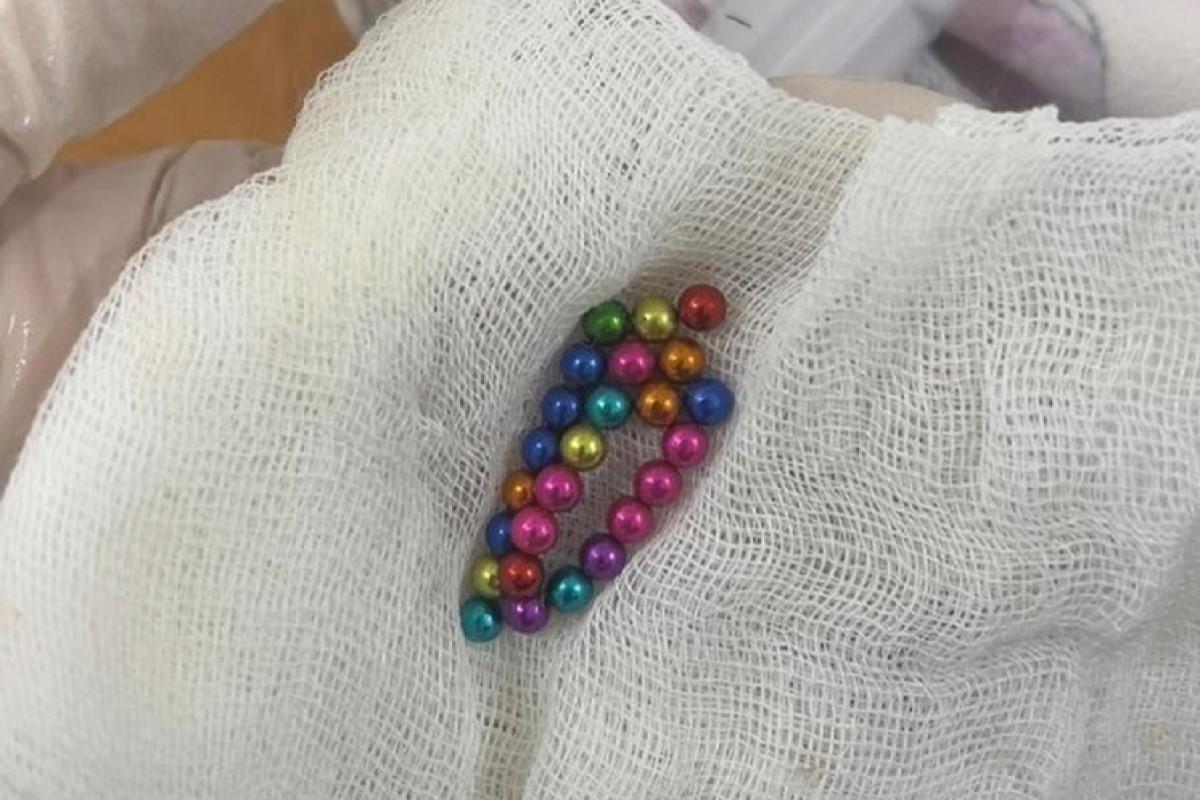 В Томской области врачи спасли ребенка, проглотившего 34 магнита