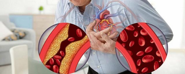 Американские ученые выявили форму «плохого» холестерина, приводящую к болезням сердца