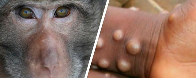 Вирус обезьяньей оспы: новая пандемия и угроза человечеству или короткая вспышка?