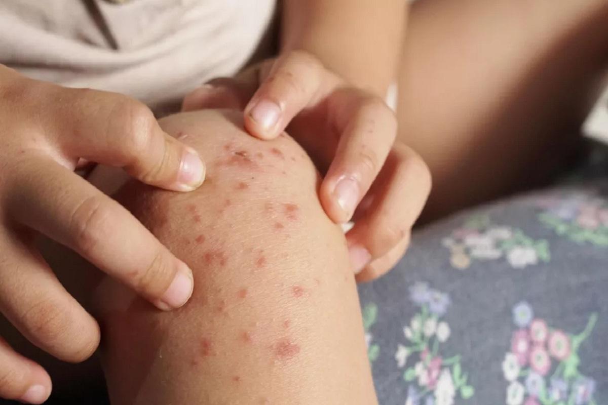 Роспотребнадзор: случаев завоза в Россию вируса Коксаки не зарегистрировано