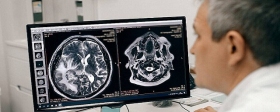 Ученые из Сеченовского университета нашли способ борьбы с опухолью мозга