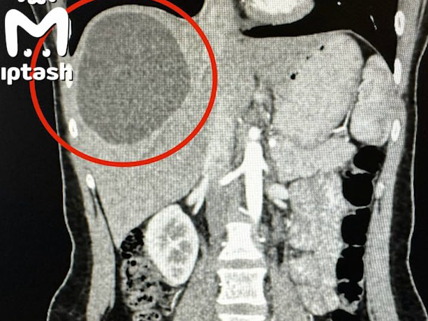В Казани врачи достали из печени пациентки огромный клубок червей