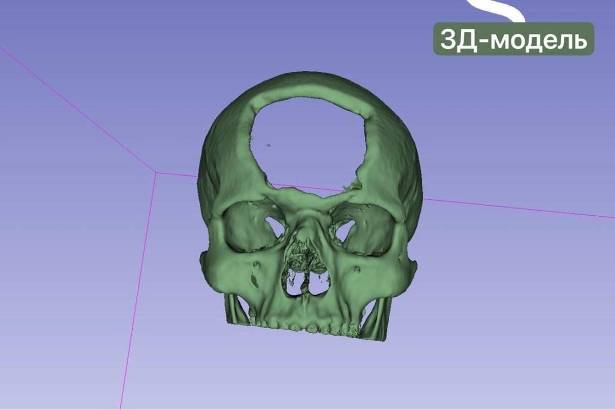 В РКБ Татарстана с помощью 3D-принтера раненому бойцу восстановили кости черепа