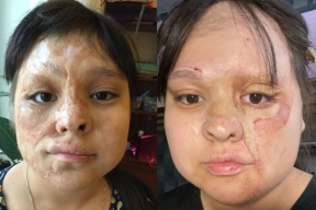 Хирурги смогли восстановить обожженное лицо девочки