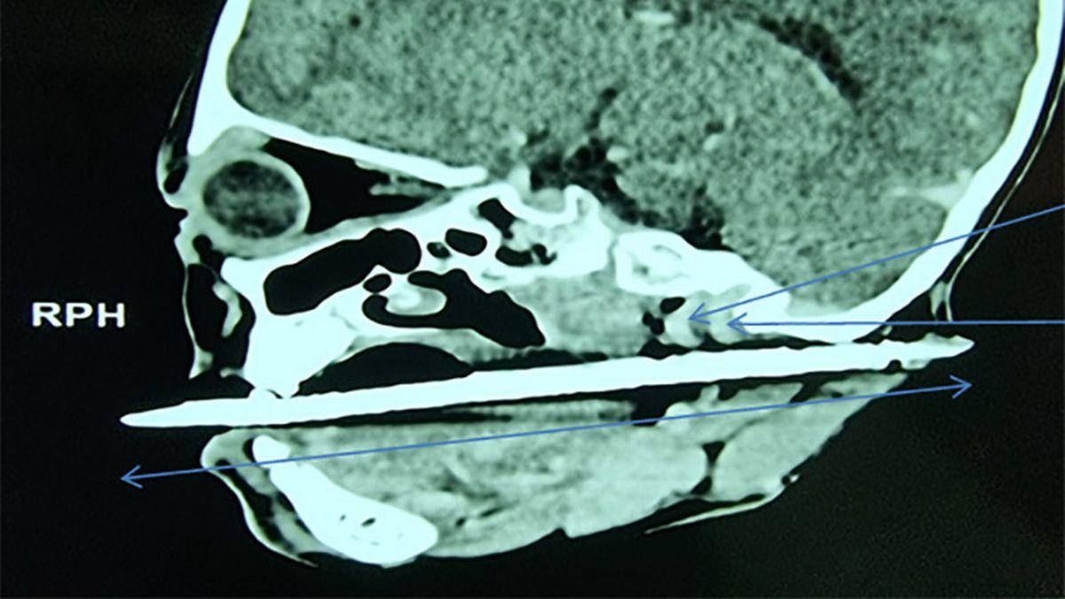 В Мали девочка,6 лет, споткнулась о заколку для волос, которая застряла у неё в горле