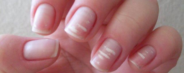 Доктор Мясников советует не прятать ногти под маникюром