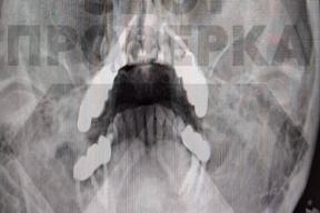 Жительнице Владимира стоматологи изуродовали лицо установкой имплантов