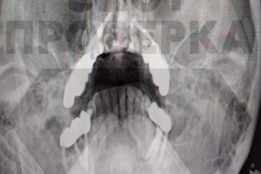 Жительнице Владимира стоматологи изуродовали лицо установкой имплантов