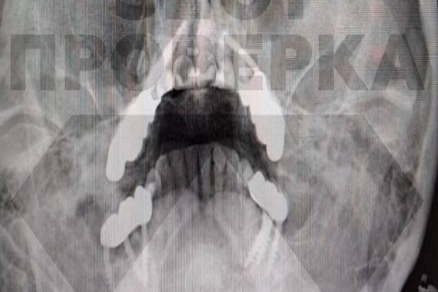 Жительнице Владимира стоматологи изуродовали лицо установкой имплантов