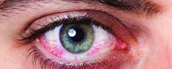 Касается каждого: что такое синдром сухого глаза и как с ним бороться