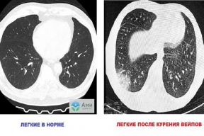 Врач Нефедов предупредил об опасности курения вейпов