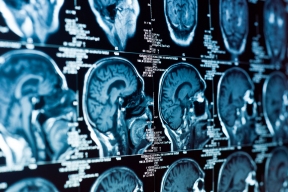 Scientists from an American university have found out why there is no cure for brain cancer