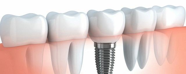 Стоматолог Балакирева предупредила, что людям с диабетом и лейкозом противопоказана установка зубных имплантов