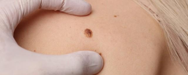 The Huntsman Cancer Institute examines the formation of melanoma from a mole