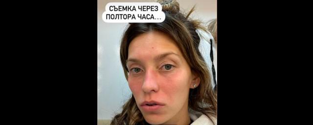 Телеведущая Регина Тодоренко пожаловалась на покраснения на лице из-за аллергической реакции