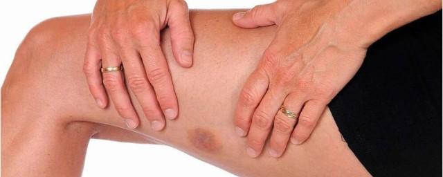 Blood Cancer UK: Skin bruising may indicate blood cancer