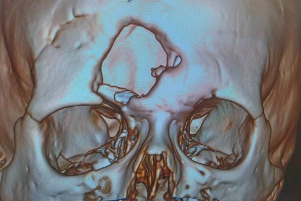 В Башкирии врачи провели уникальную операцию девушке, жившей с отверстием во лбу