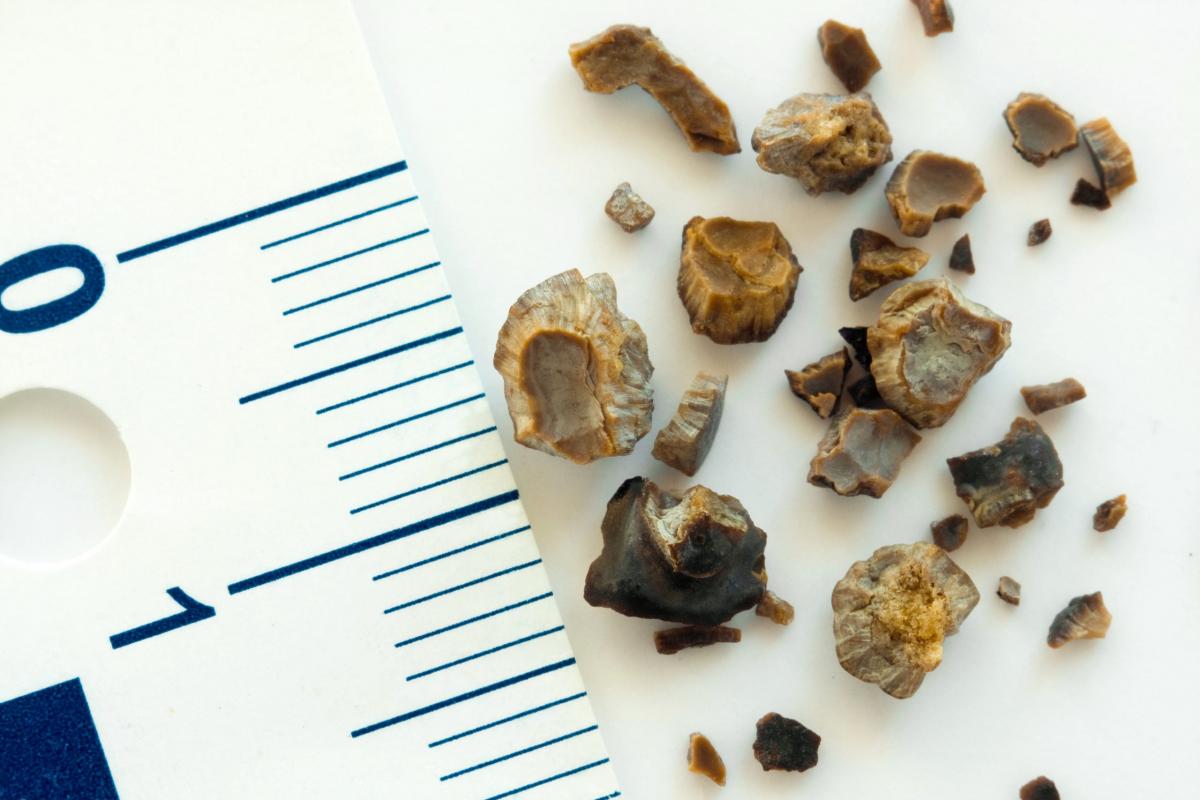 Doctors in Ulan-Ude have learned to erase kidney stones into dust