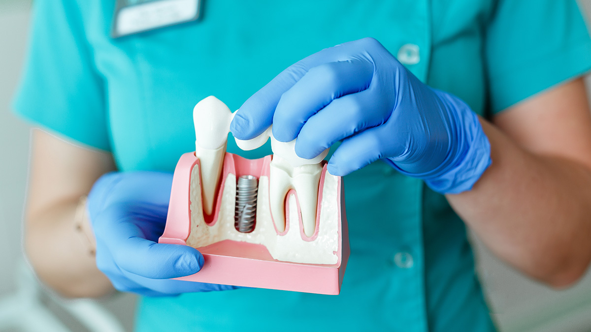 Стоматолог рассказал, почему лучше поставить имплант после удаления зуба