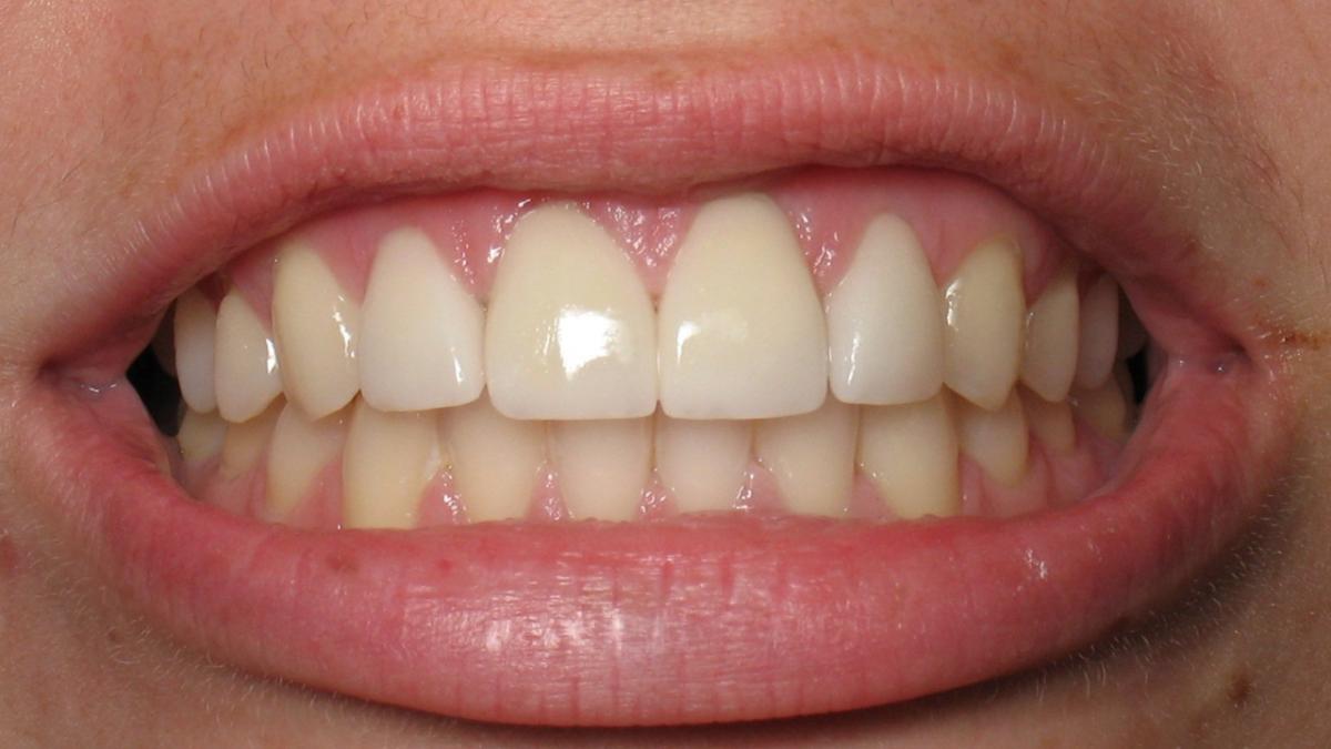 Ученые установили необычную связь между зубами и эволюцией человека