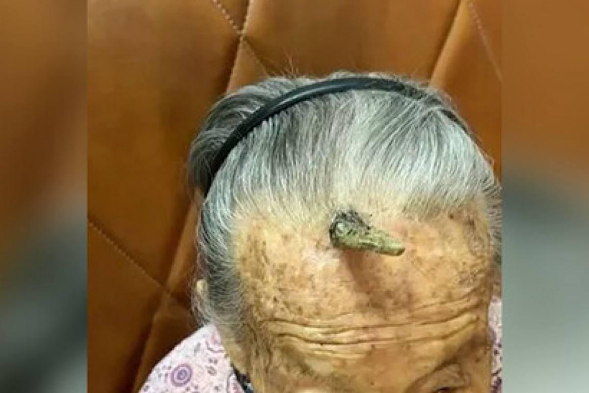 Почти столетняяя китаянка чуть не погибла, отрезав себе «рог долгожителя»