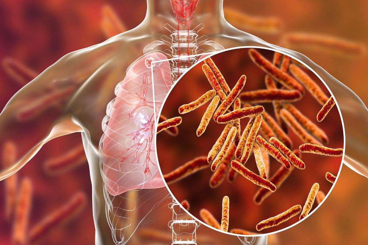 Иркутские ученые изучают микробов в  туберкулезных очагах в легком, чтобы эффективно бороться с болезнью